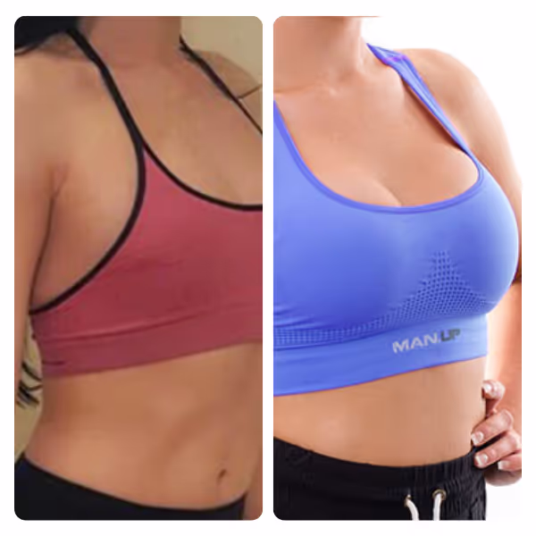 Breast Lift in Turkey